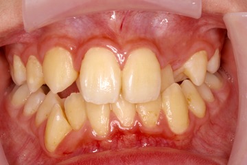 ケースNo.1 治療前 (1).jpg
